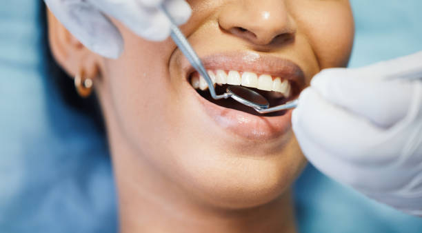 Best Chipped Tooth Repair Near Me  in Burlington, CO