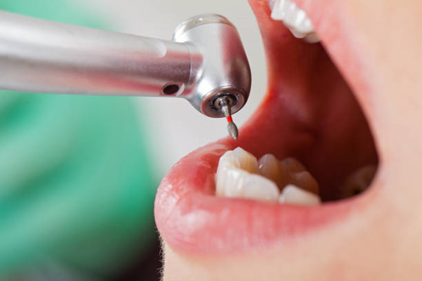 Best Broken Tooth Emergency  in Burlington, CO